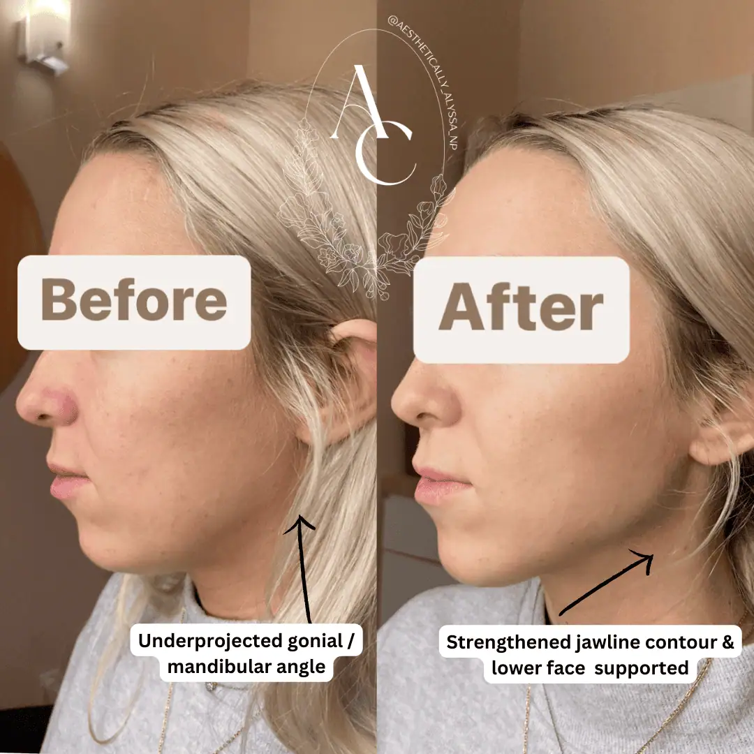 Cheek Filler in New York | Timelyss Med Spa