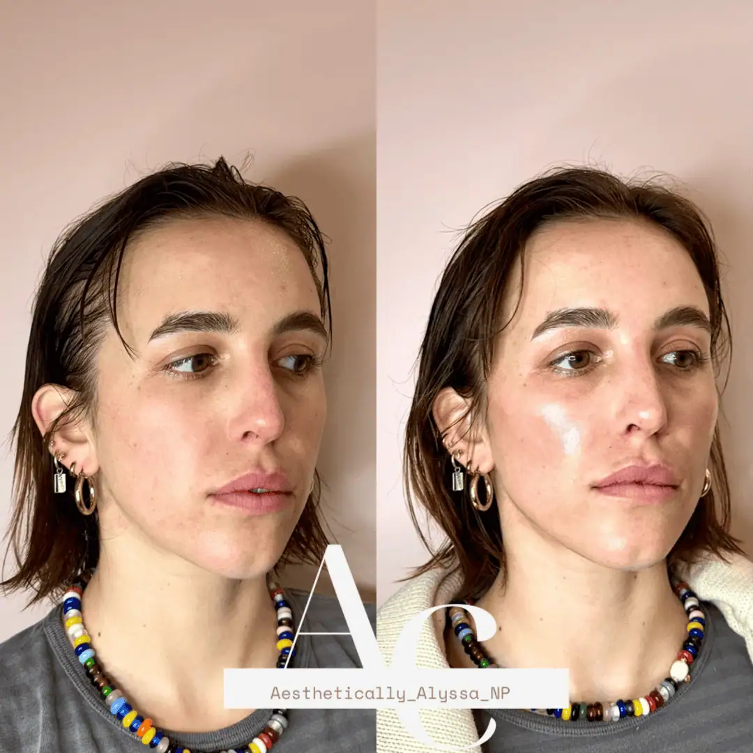 Cheek Filler in New York | Timelyss Med Spa