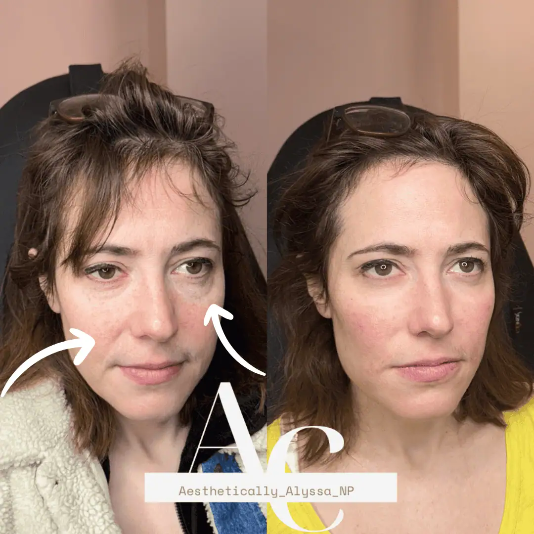 Cheek Filler in New York | Timelyss Med Spa