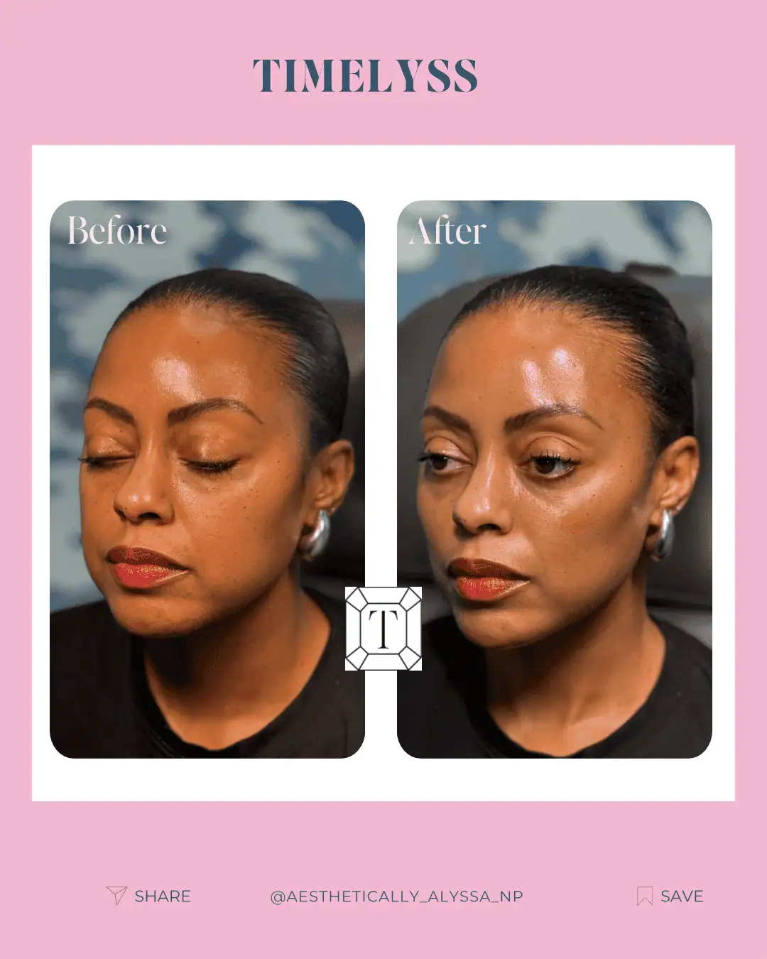 Cheek Filler in New York | Timelyss Med Spa