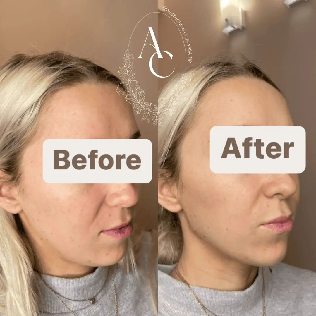 Cheek Filler in New York | Timelyss Med Spa