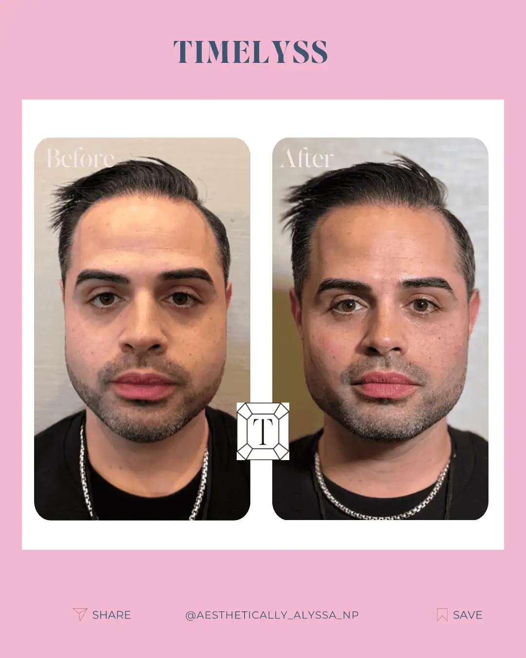 Cheek Filler in New York | Timelyss Med Spa