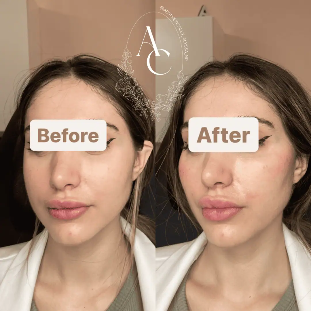 Cheek Filler in New York | Timelyss Med Spa
