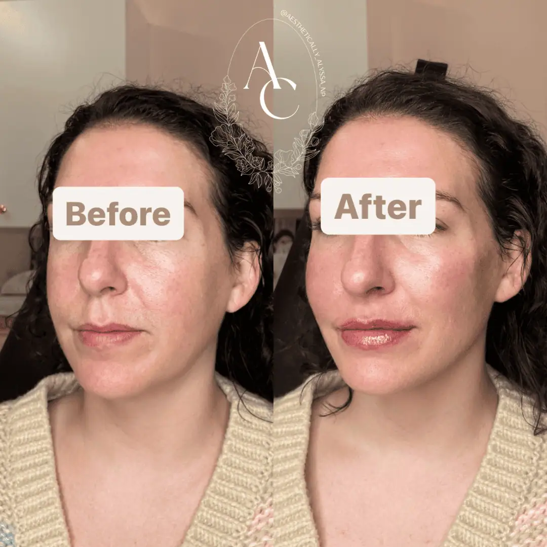 Cheek Filler in New York | Timelyss Med Spa