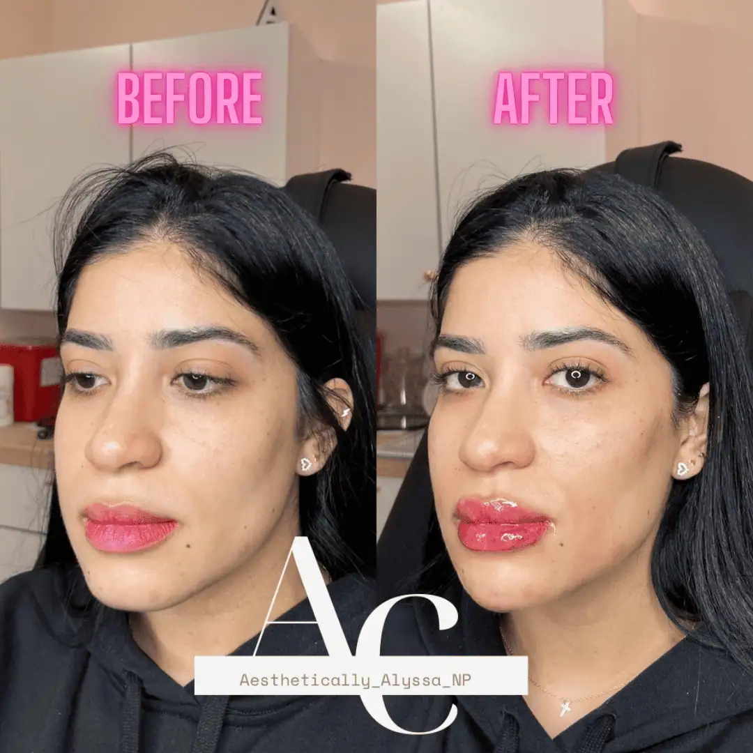 Cheek Filler in New York | Timelyss Med Spa