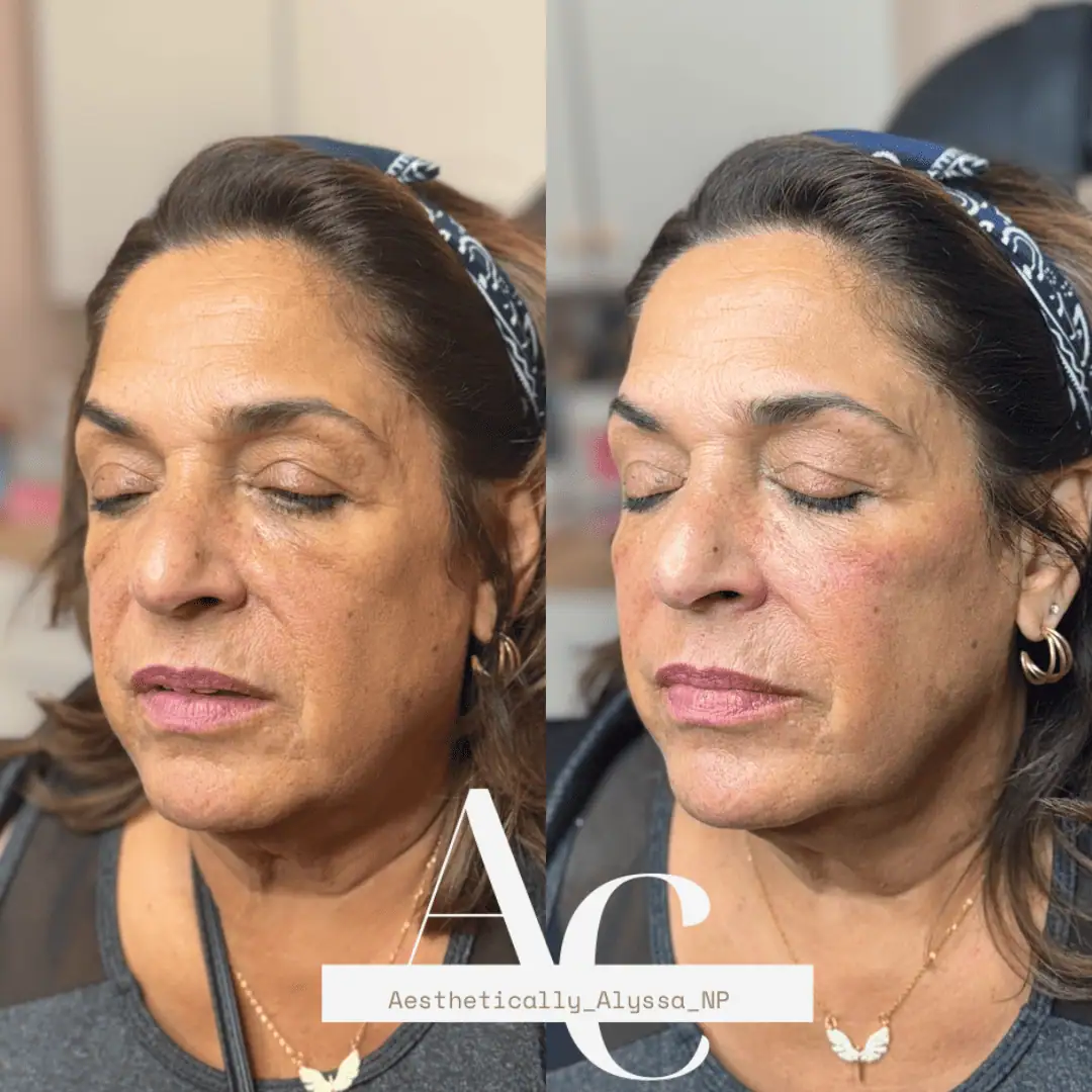 Cheek Filler in New York | Timelyss Med Spa