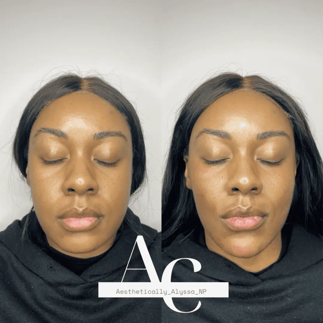 Cheek Filler in New York | Timelyss Med Spa