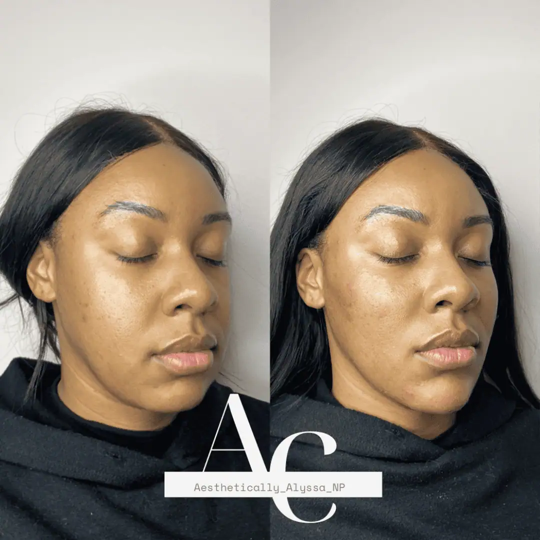 Cheek Filler in New York | Timelyss Med Spa