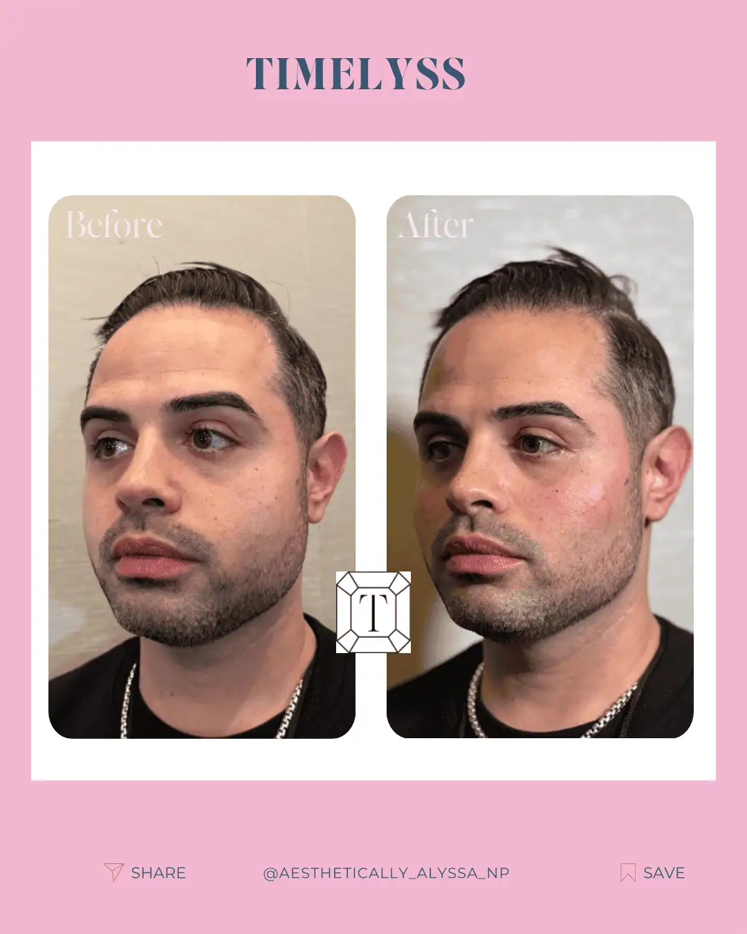 Cheek Filler in New York | Timelyss Med Spa