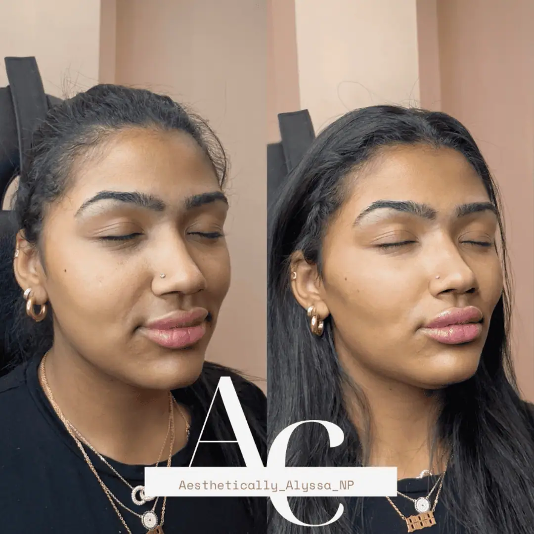 Cheek Filler in New York | Timelyss Med Spa