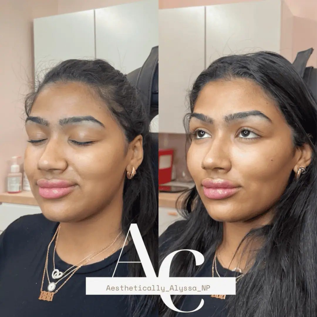 Cheek Filler in New York | Timelyss Med Spa