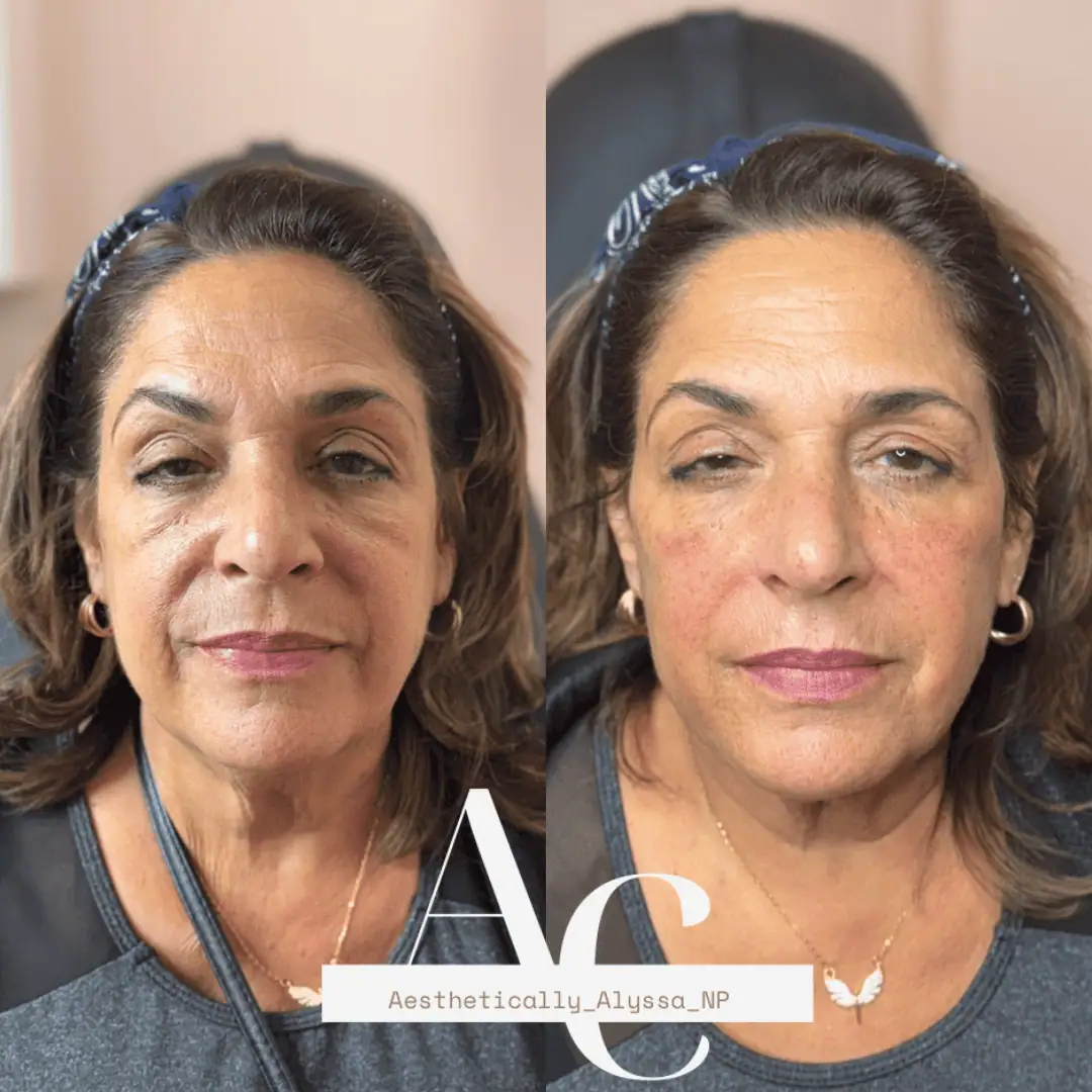 Cheek Filler in New York | Timelyss Med Spa