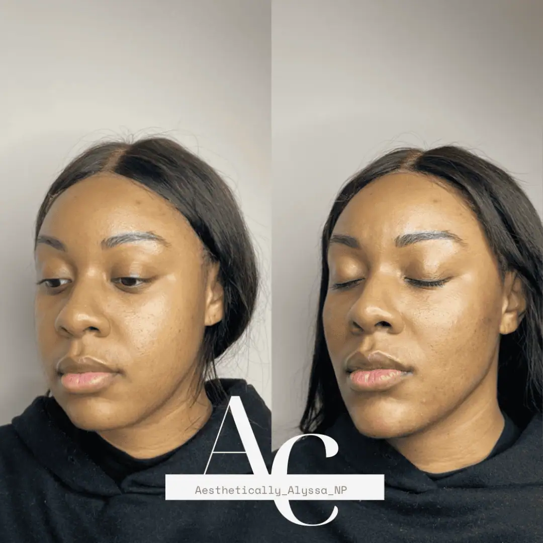 Cheek Filler in New York | Timelyss Med Spa