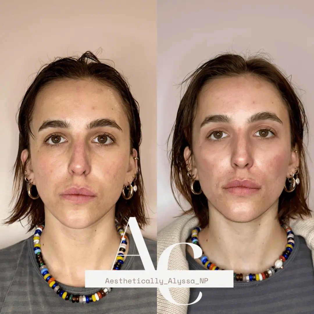 Cheek Filler in New York | Timelyss Med Spa