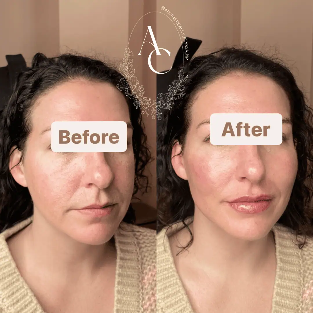 Cheek Filler in New York | Timelyss Med Spa