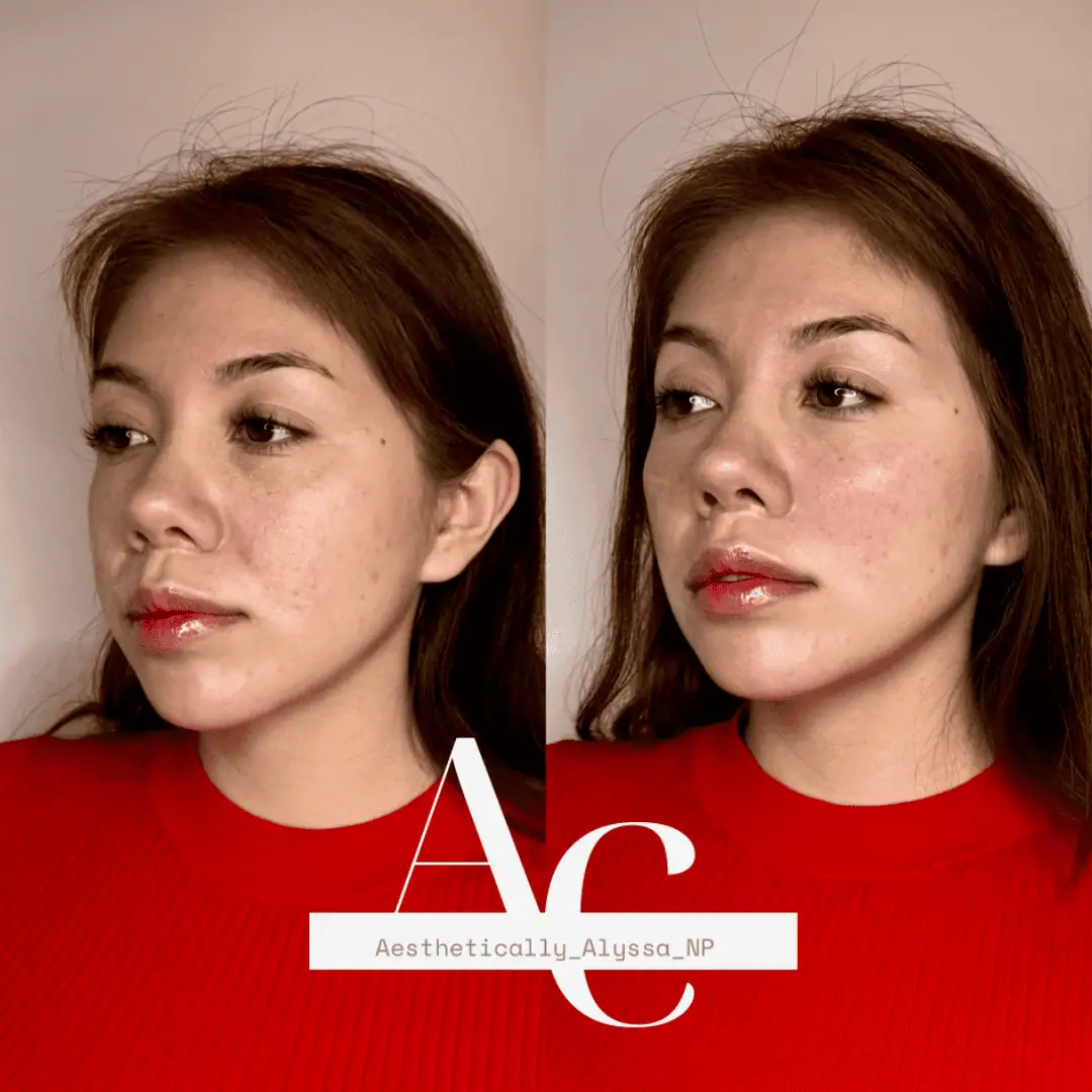 Cheek Filler in New York | Timelyss Med Spa