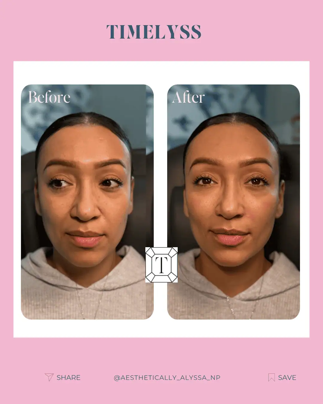 Cheek Filler in New York | Timelyss Med Spa