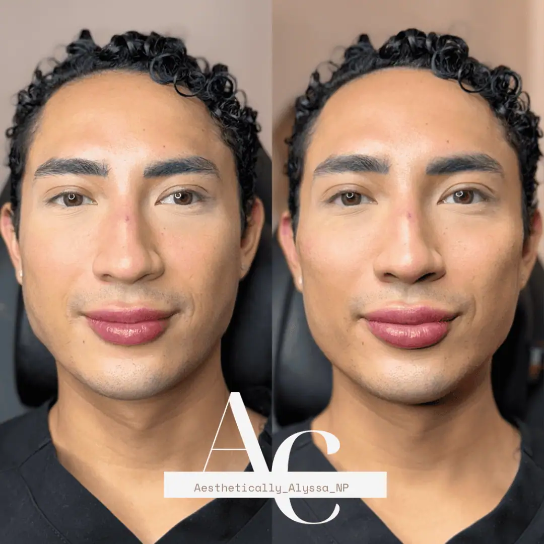 Cheek Filler in New York | Timelyss Med Spa