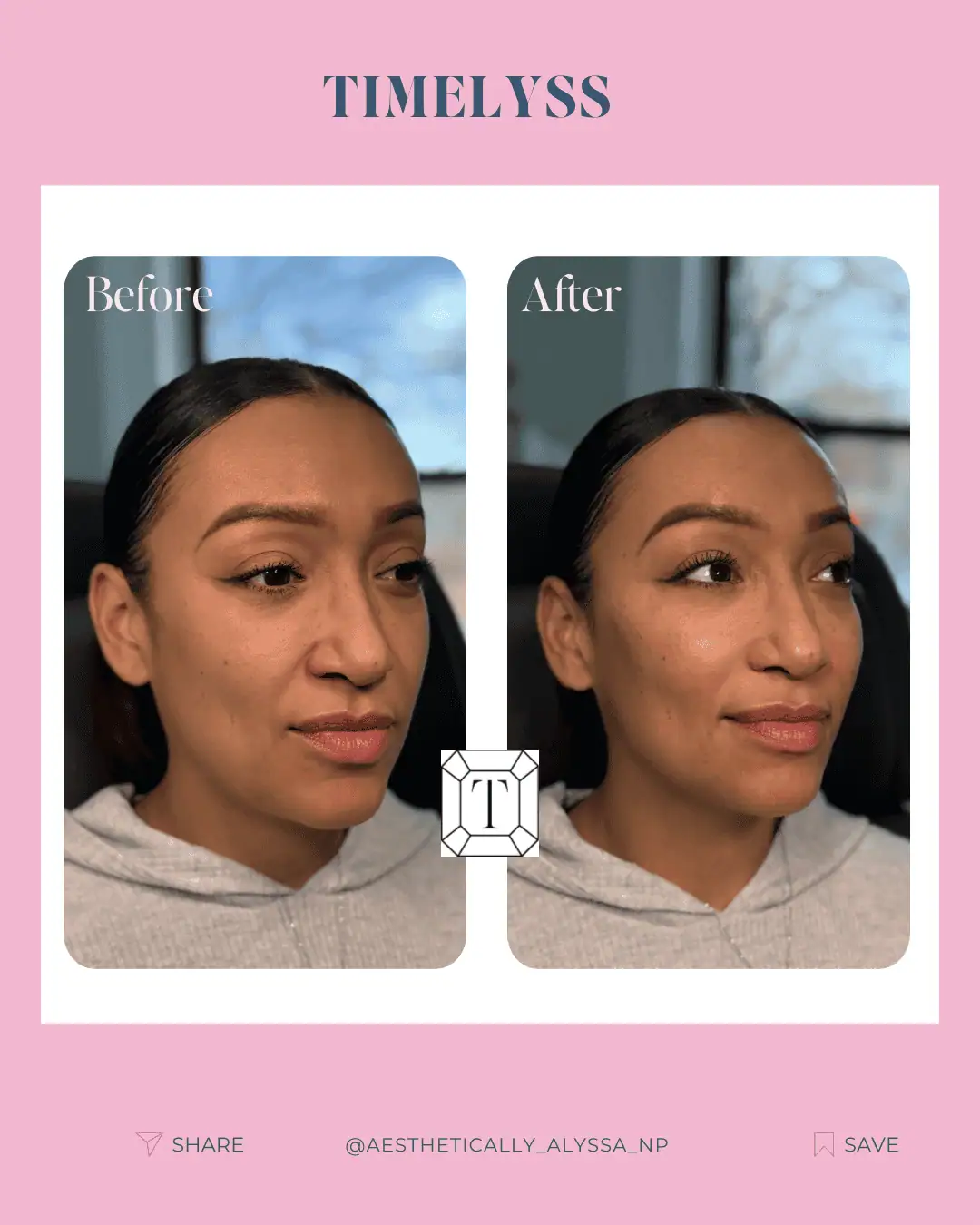 Cheek Filler in New York | Timelyss Med Spa