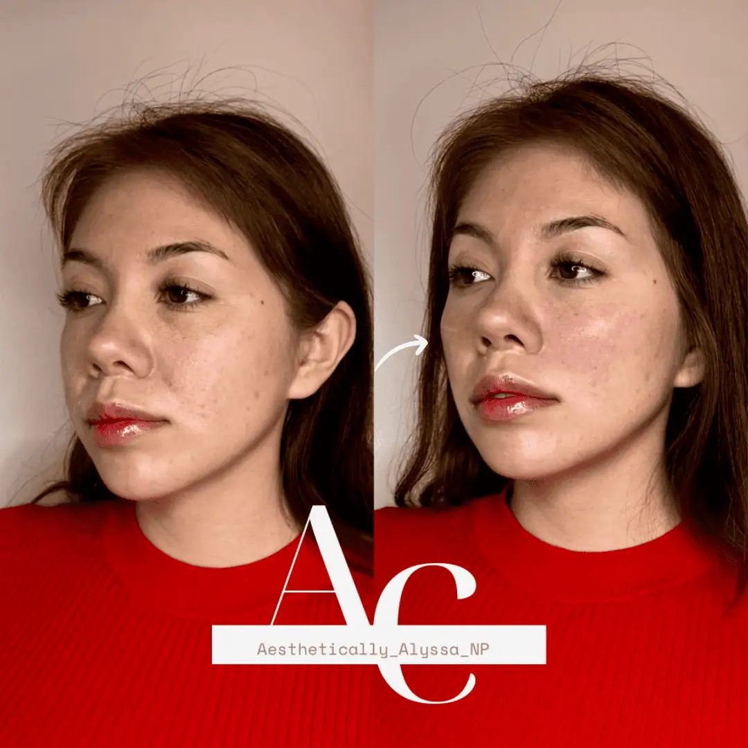 Cheek Filler in New York | Timelyss Med Spa