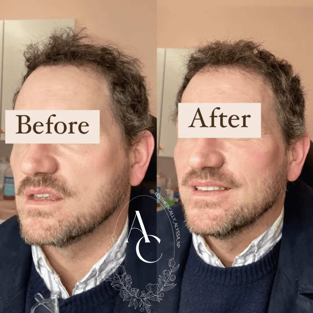 Cheek Filler in New York | Timelyss Med Spa