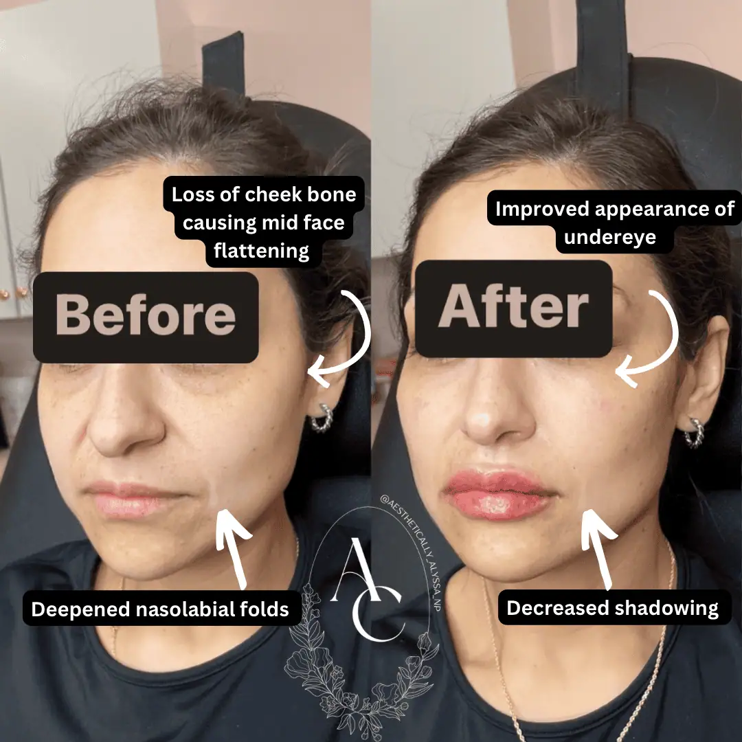 Cheek Filler in New York | Timelyss Med Spa