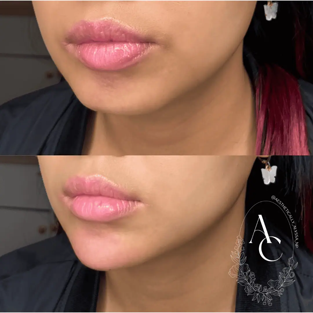 Chin Fillers in New York | Timelyss Med Spa