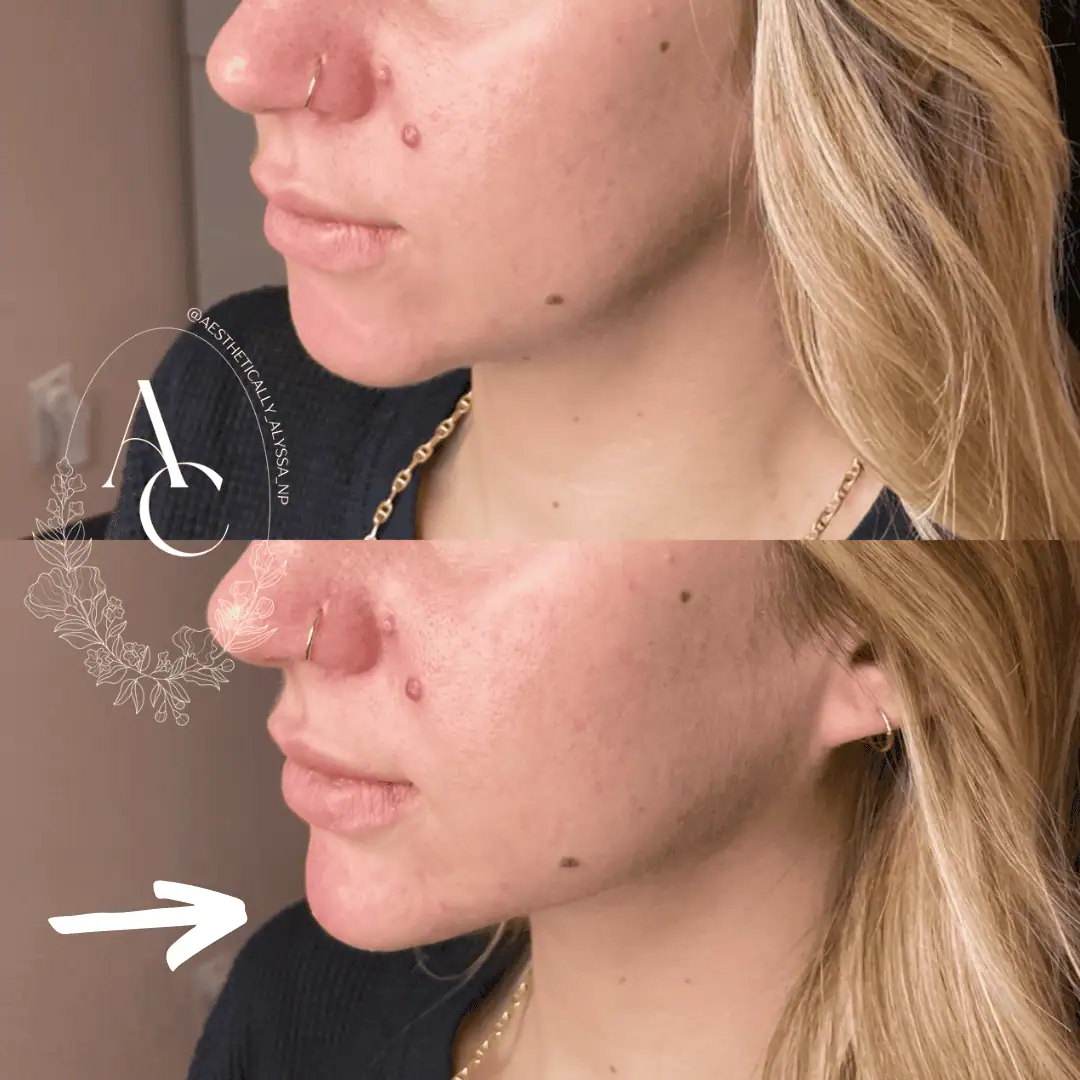Chin Filler in New York | Timelyss Med Spa