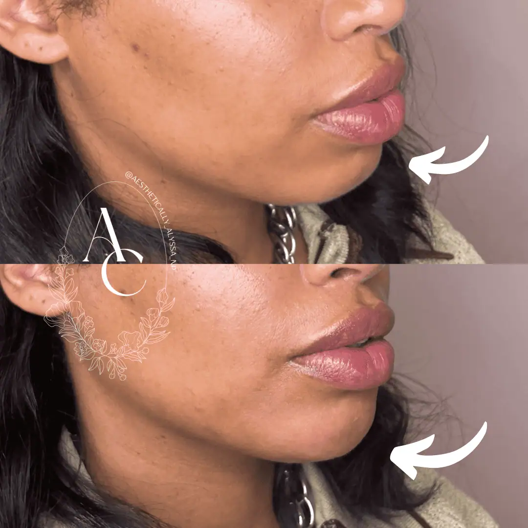 Chin Filler in New York | Timelyss Med Spa