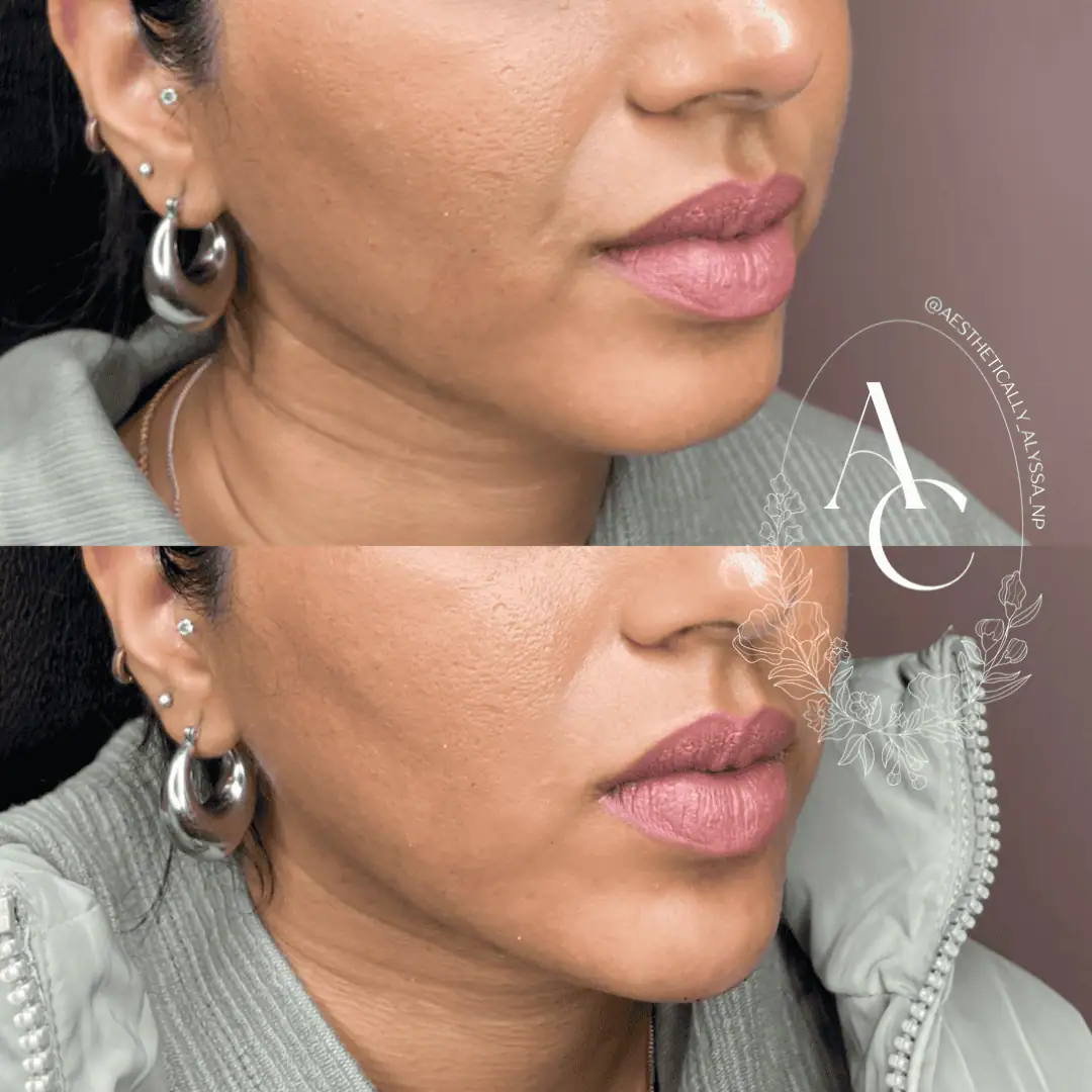 Chin Fillers in New York | Timelyss Med Spa