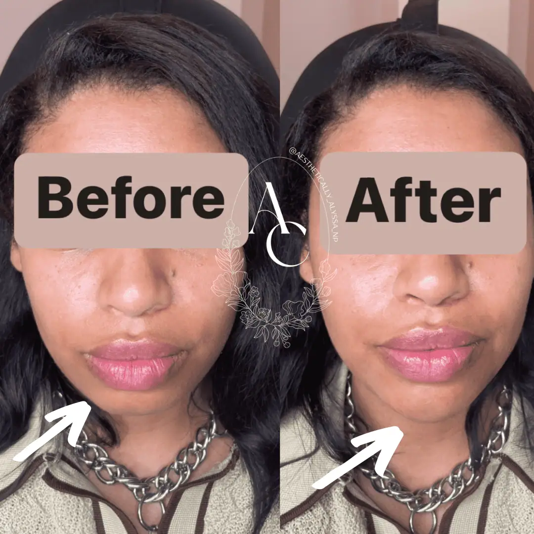 Chin Fillers in New York | Timelyss Med Spa