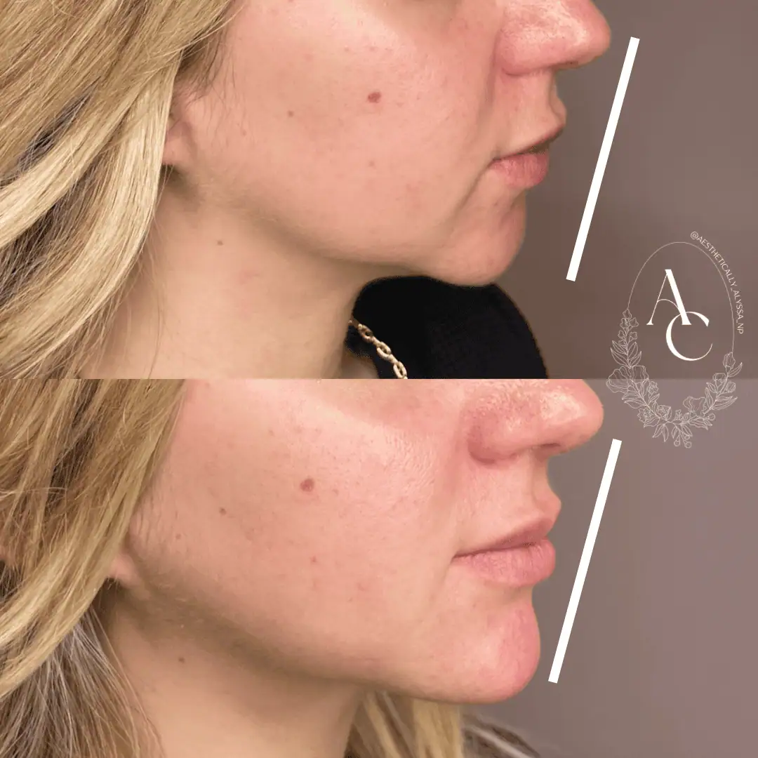 Chin Fillers in New York | Timelyss Med Spa