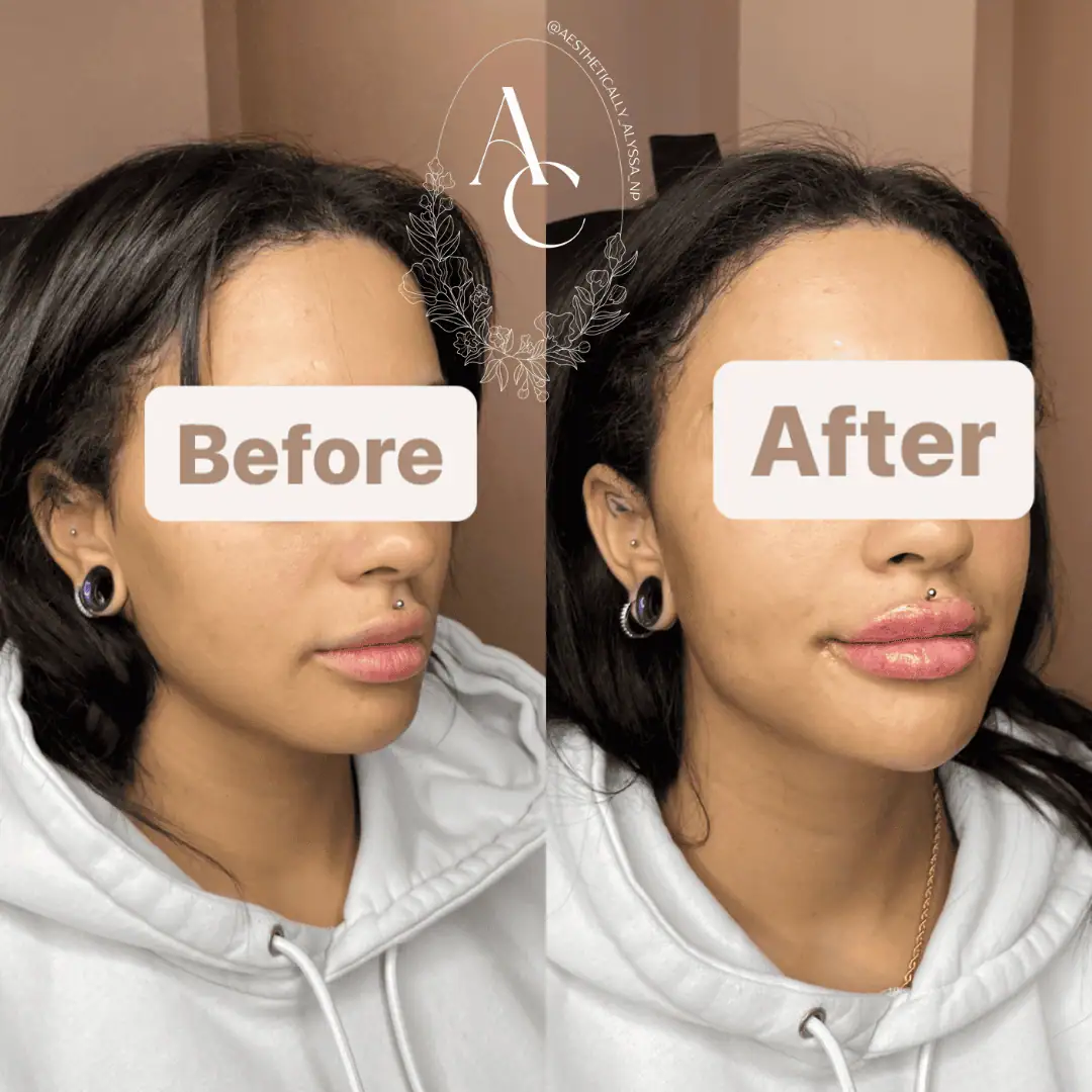 Chin Filler in New York | Timelyss Med Spa