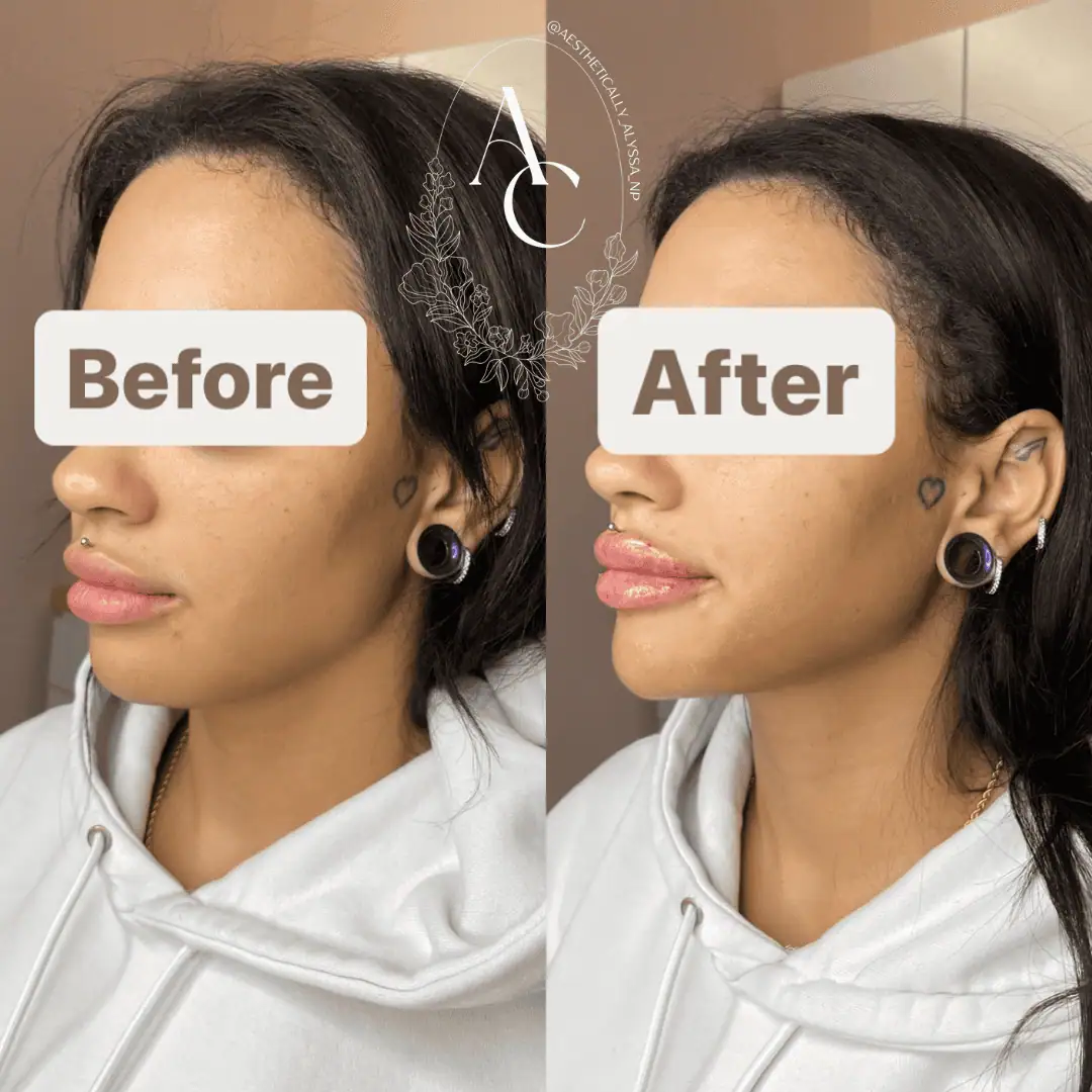 Chin Filler in New York | Timelyss Med Spa