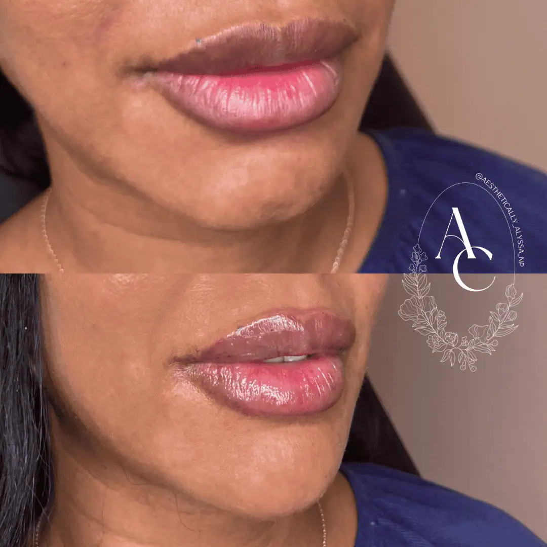 Chin Filler in New York | Timelyss Med Spa