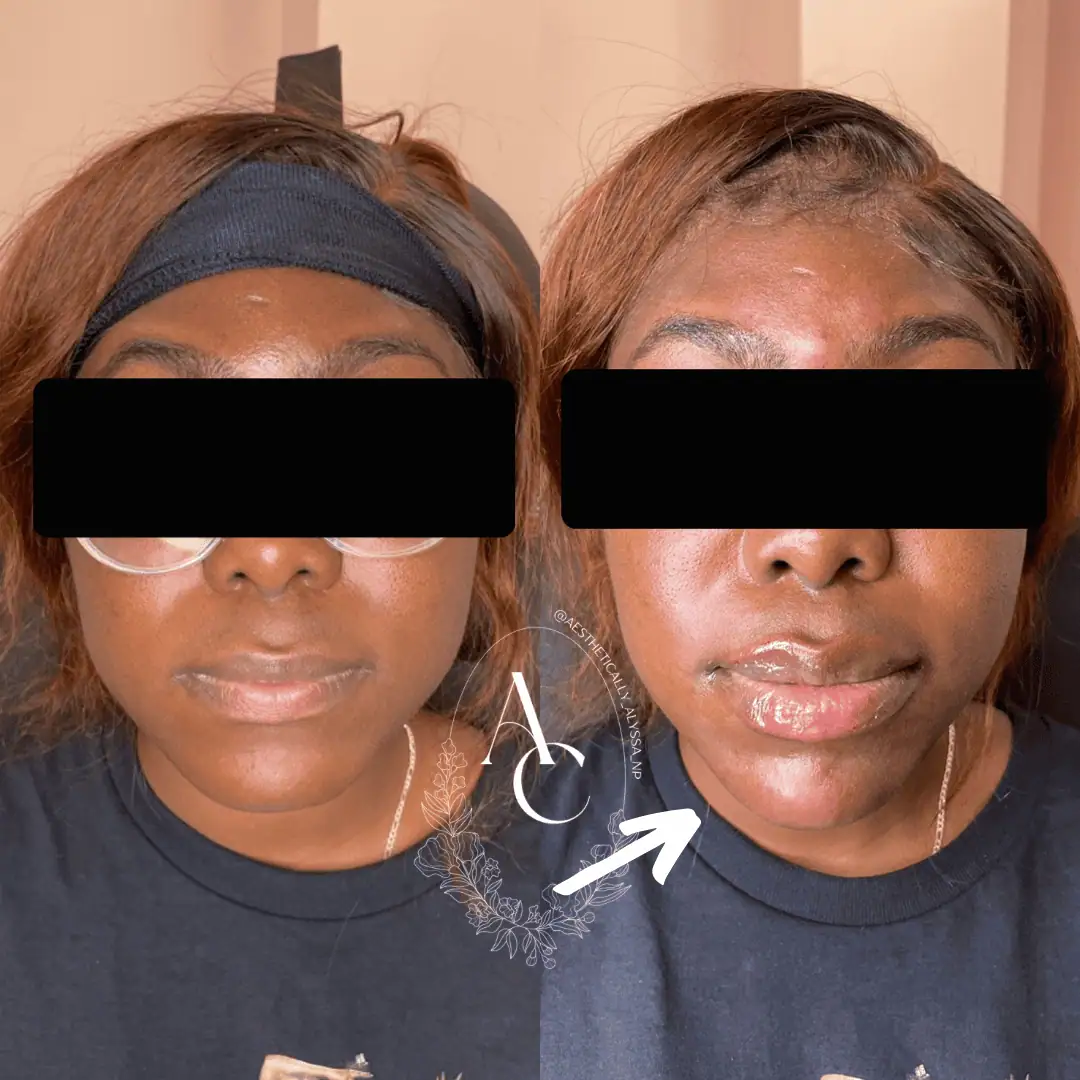 Chin Fillers in New York | Timelyss Med Spa