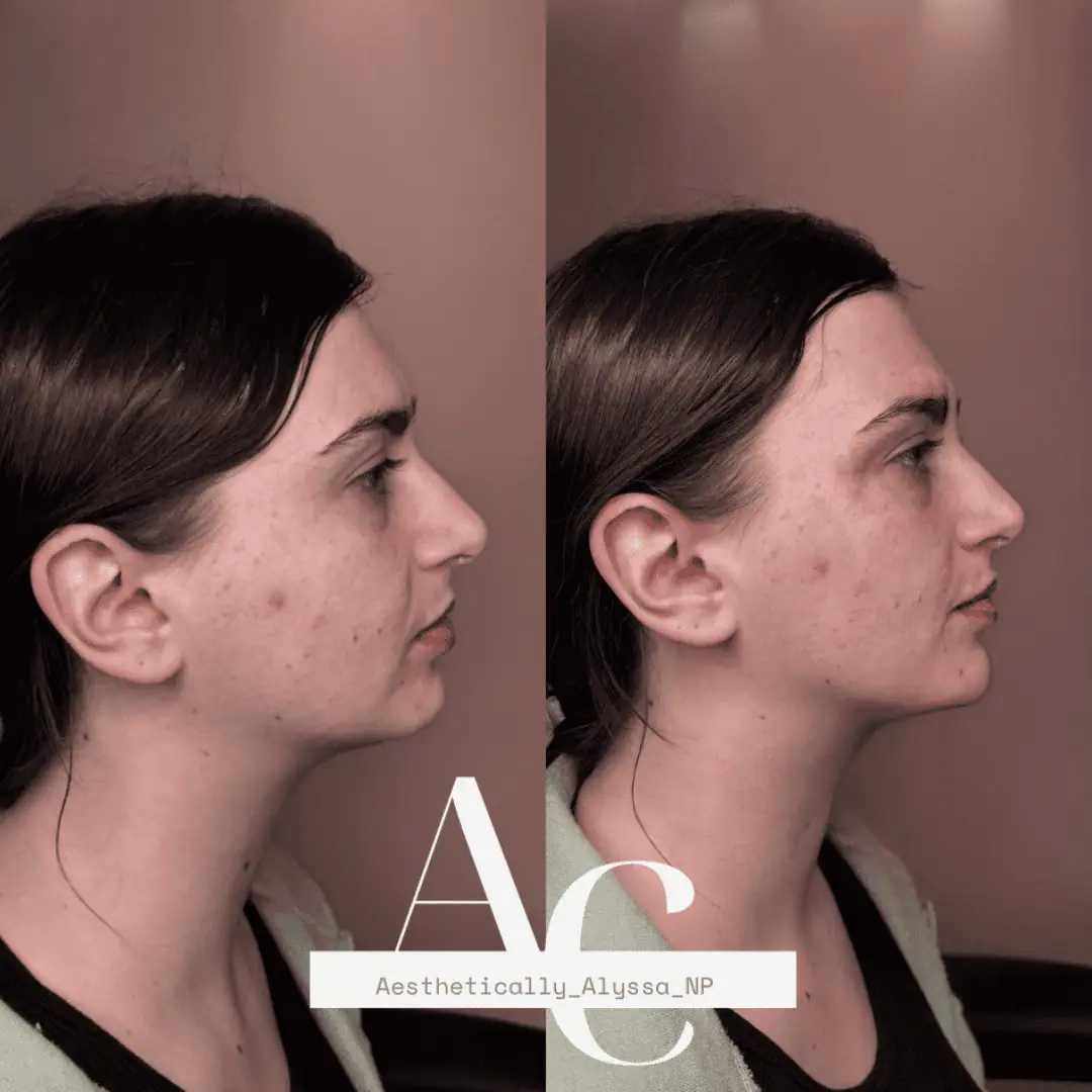 Chin Filler in New York | Timelyss Med Spa