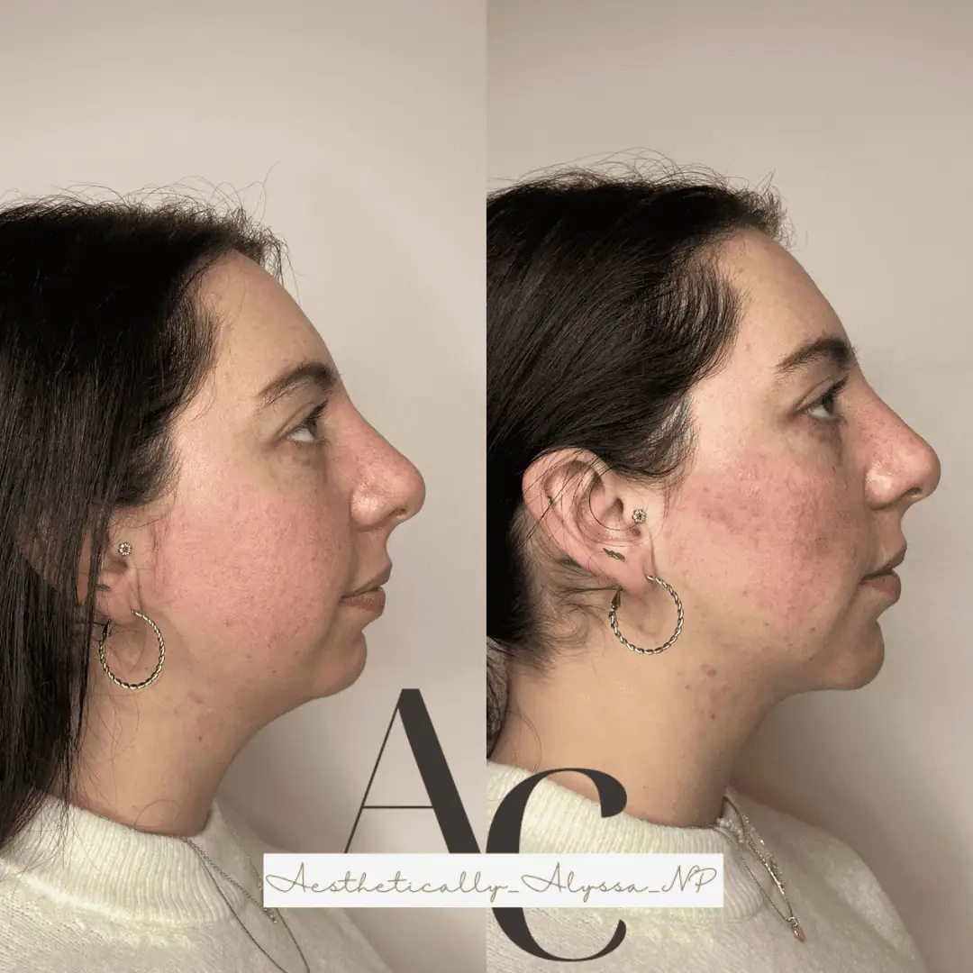 Chin Filler in New York | Timelyss Med Spa