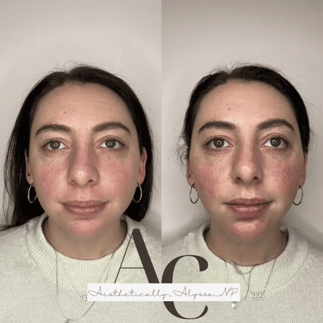 Chin Filler in New York | Timelyss Med Spa