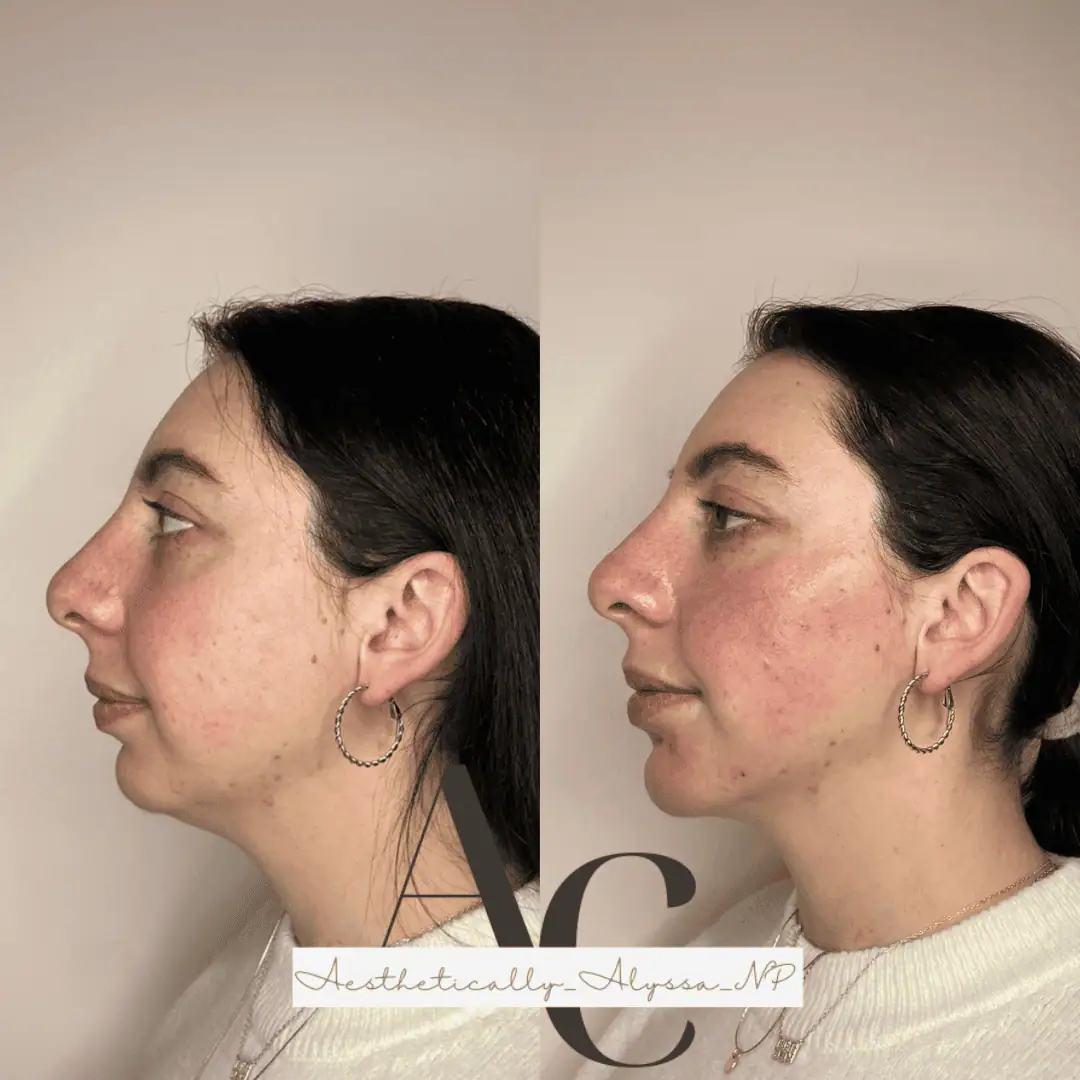 Chin Filler in New York | Timelyss Med Spa