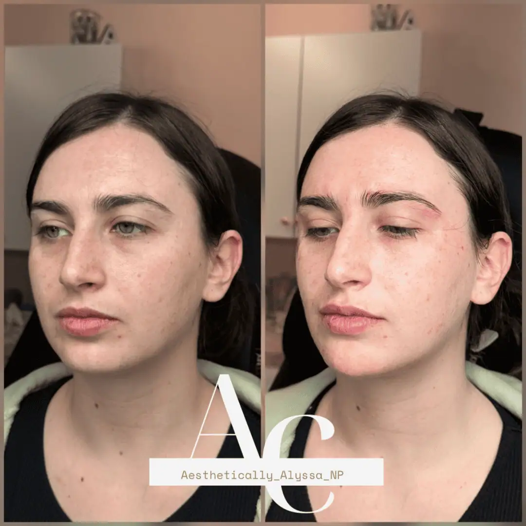 Chin Filler in New York | Timelyss Med Spa