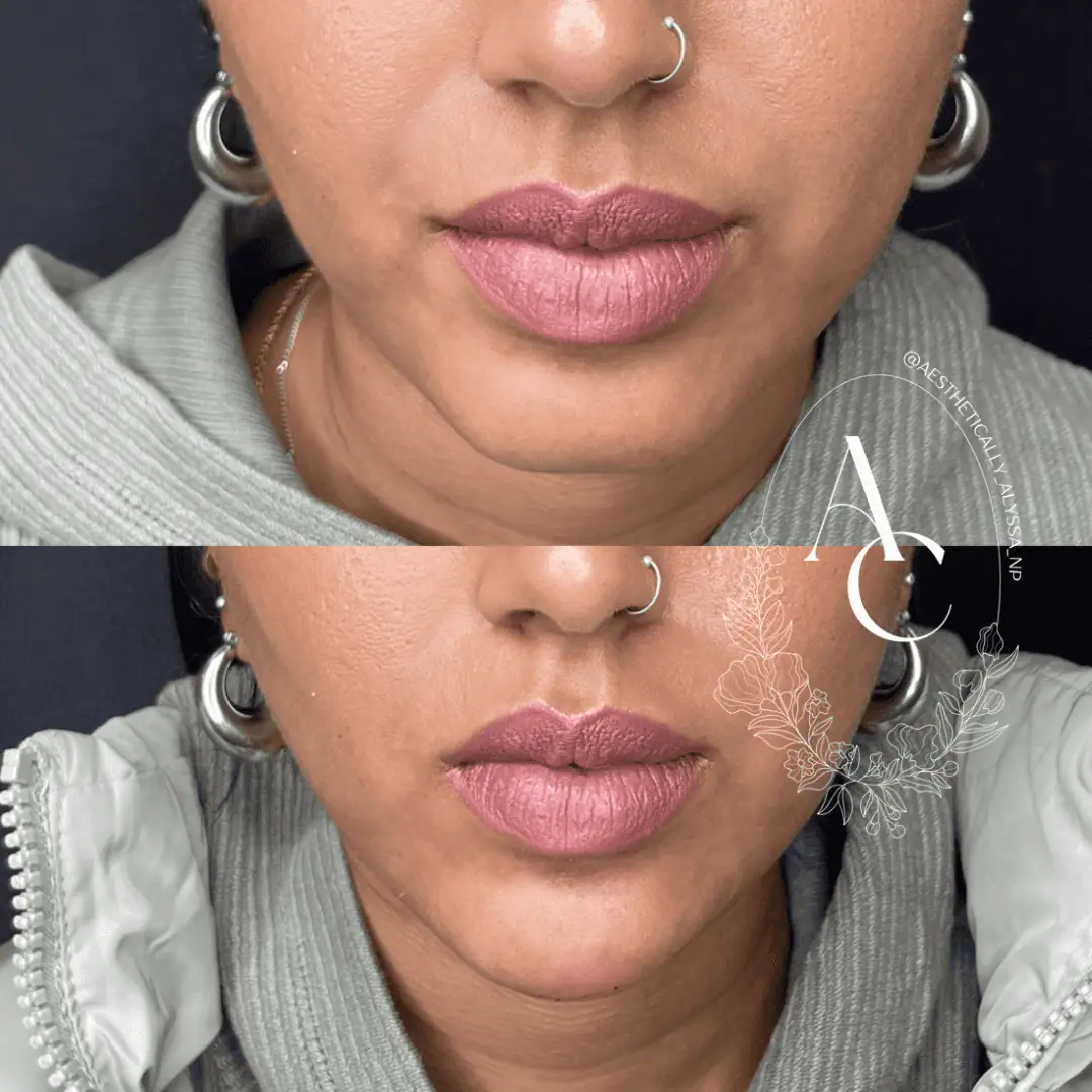 Chin Fillers in New York | Timelyss Med Spa