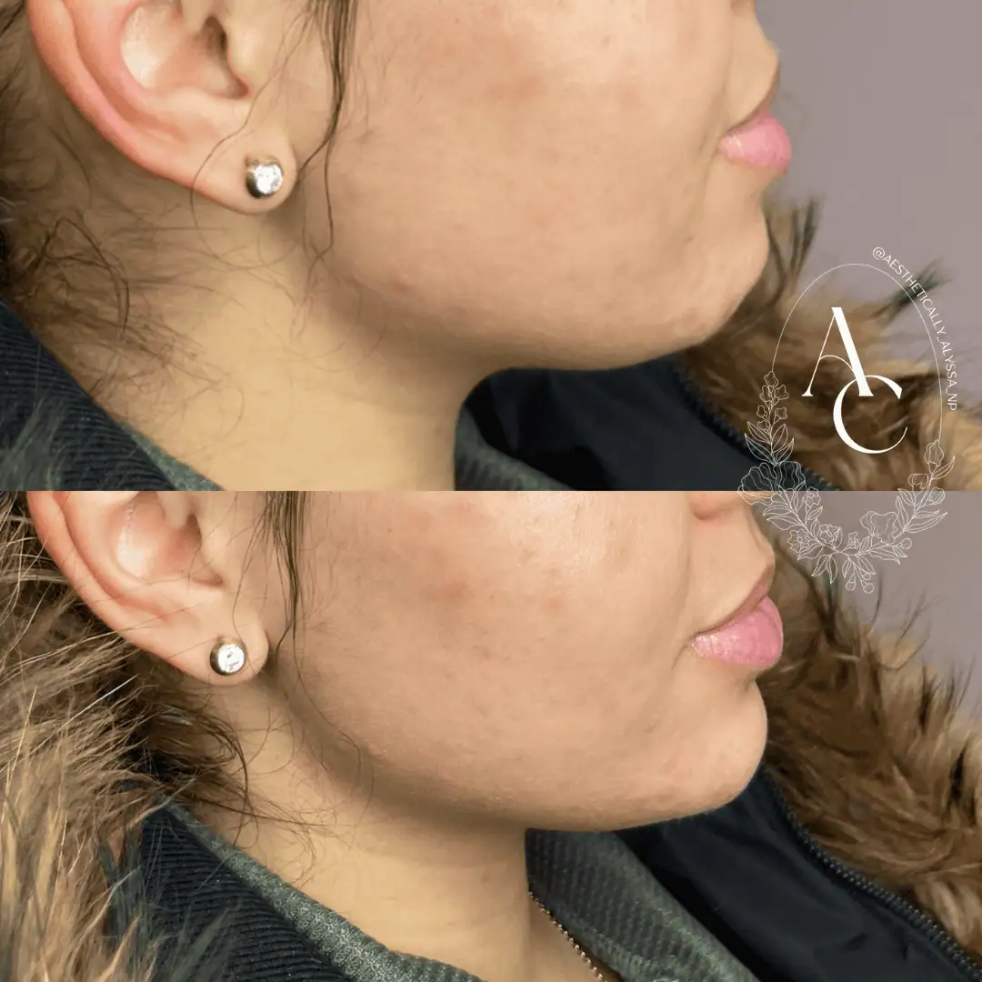 Chin Filler in New York | Timelyss Med Spa