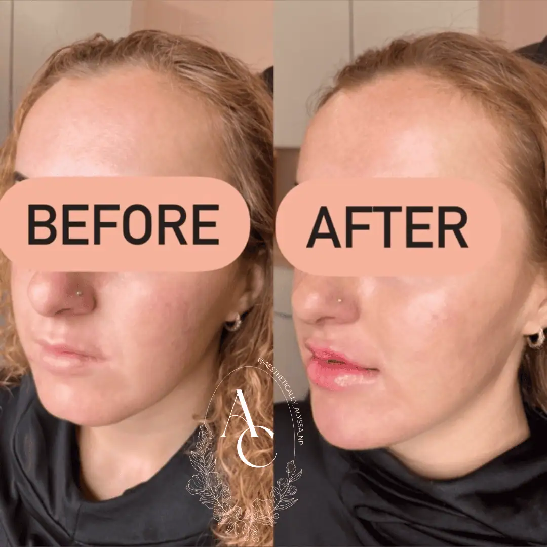 Chin Filler in New York | Timelyss Med Spa