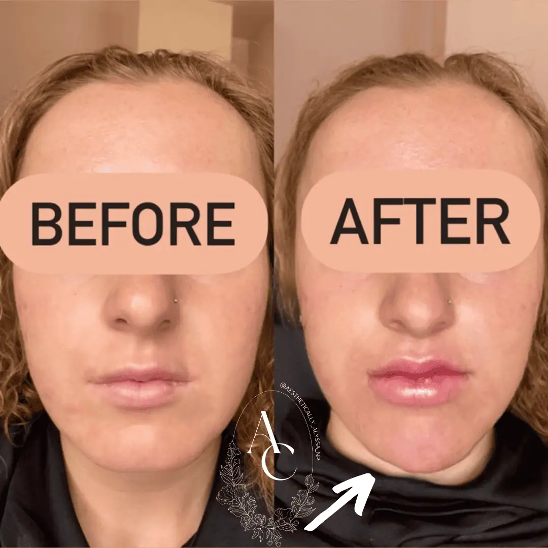 Chin Filler in New York | Timelyss Med Spa