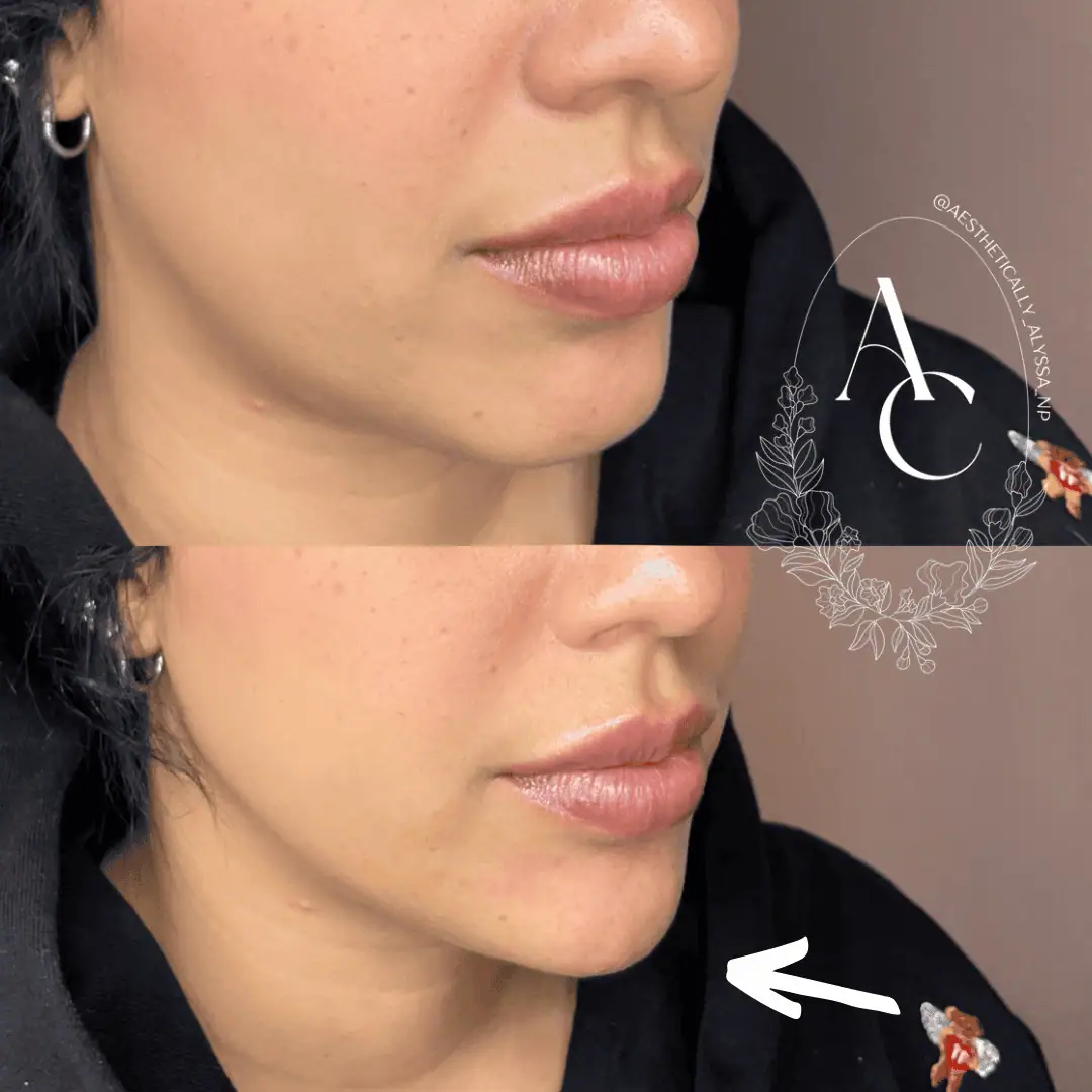 Chin Filler in New York | Timelyss Med Spa