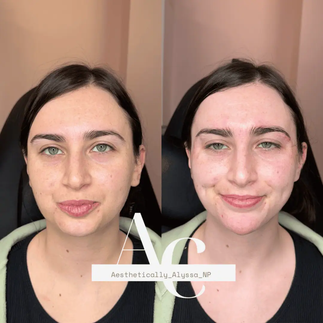 Chin Filler in New York | Timelyss Med Spa