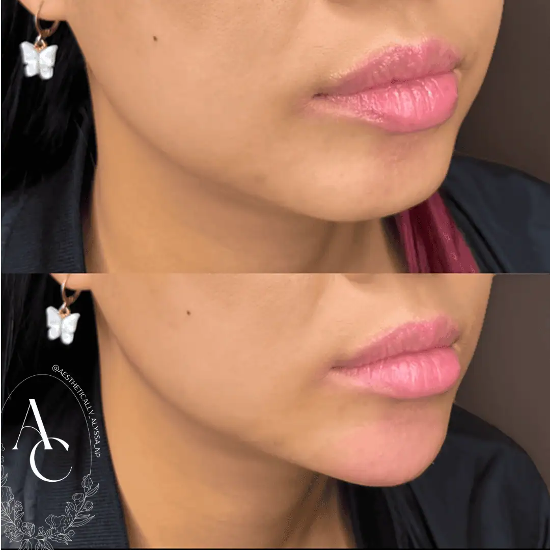 Chin Filler in New York | Timelyss Med Spa