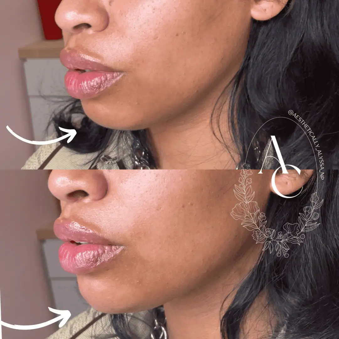 Chin Filler in New York | Timelyss Med Spa