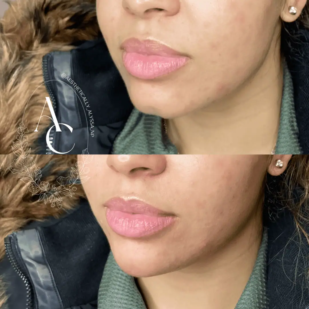 Chin Filler in New York | Timelyss Med Spa